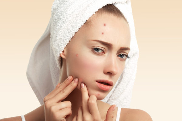 Brotes de acné en primavera, cómo tratarlos