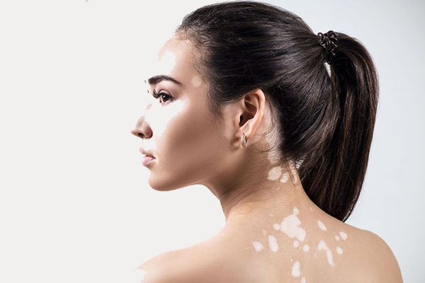 ¿Hay cura para el vitiligo?