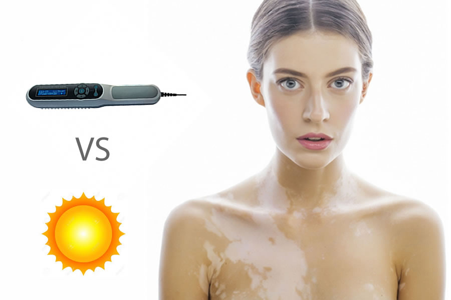 fototerapia vs exposicion solar vitiligo