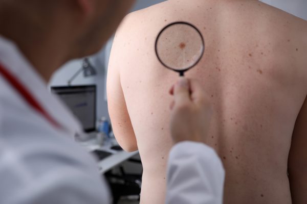 El vitíligo mejora el pronóstico de los pacientes con melanoma