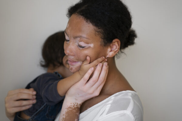 pacientes con vitiligo y salud mental
