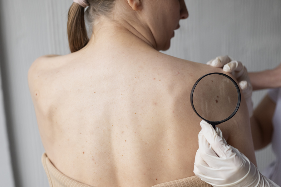 piel con vitiligo melanoma