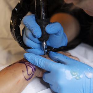 Vitíligo y tatuajes