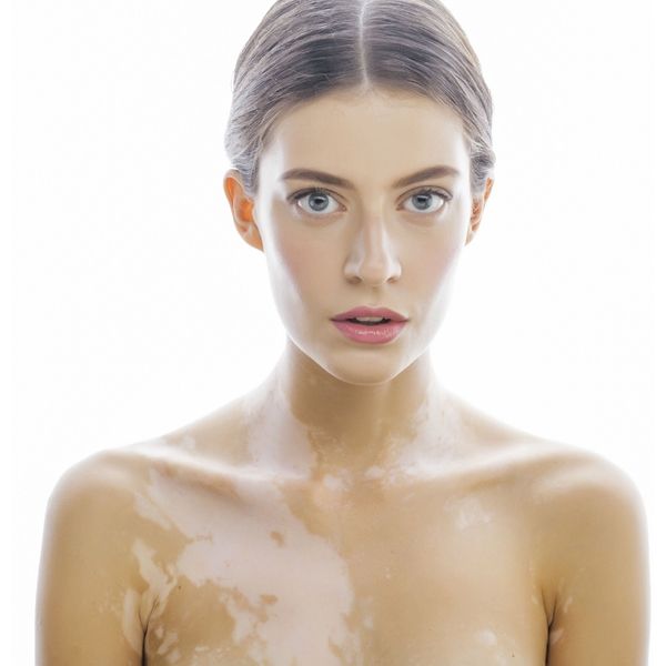 Bronceadores para el vitiligo, lámpara de fototerapia