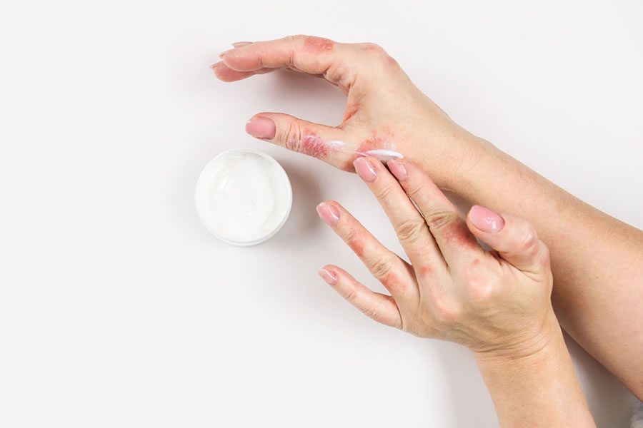 de la dermatitis con fototerapia, consejos y cuidados