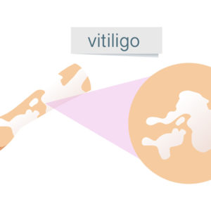 tratamiento del vitiligo
